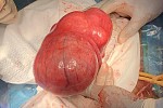 CFOMIP Retraite Spirituelle / Témoignage de reconnaissance pour la fidélité et la bonté de Dieu face à un cas de fibromes CFOMIP Retraite Spirituelle / Témoignage de reconnaissance pour la fidélité et la bonté de Dieu face à un cas de fibromes