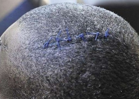 Ne supportant plus la conversion de ses fidèles au christianisme, l'imam fracture le crâne du pasteur Ne supportant plus la conversion de ses fidèles au christianisme, l'imam fracture le crâne du pasteur