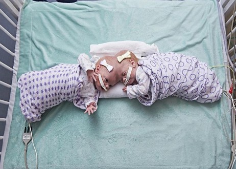 Des bébés siamois subissent une séparation chirurgicale et les parents louent Jésus-Christ pour son intervention
